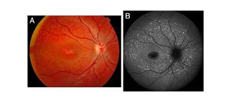 macular dystrophy