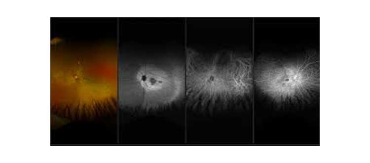 macular dystrophy