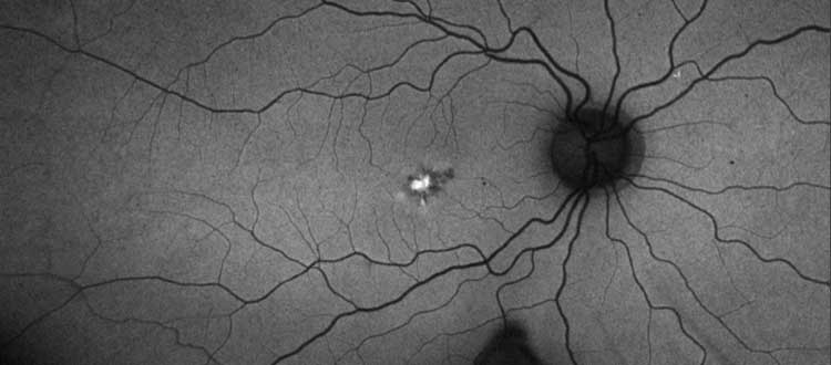 macular dystrophy