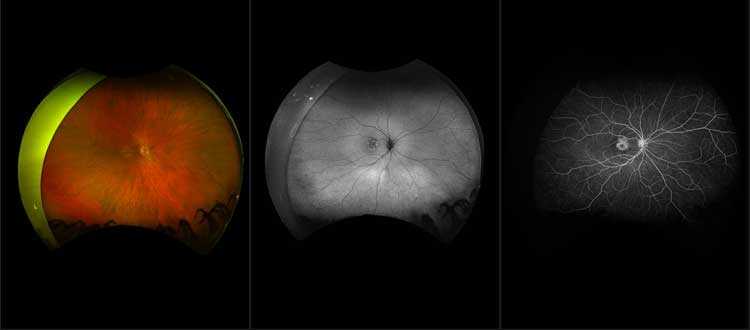 macular dystrophy