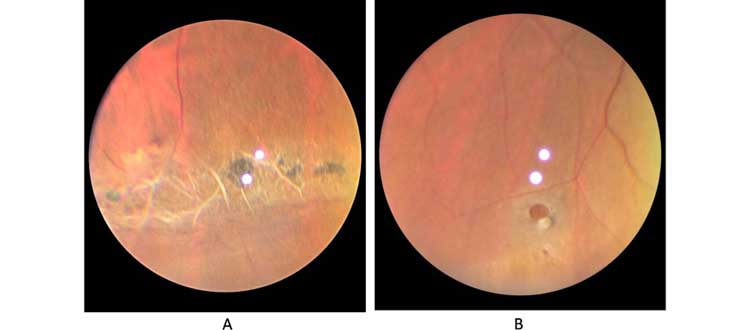 macular dystrophy