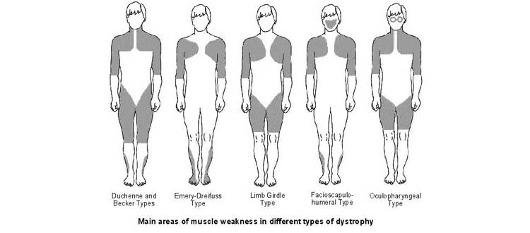 muscular dystrophy