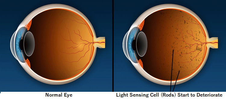 retinitis pigmentosa