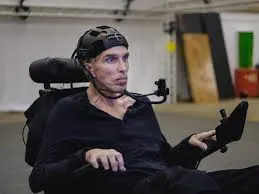 Stem Cell Treatment for Motor Neuron Disease